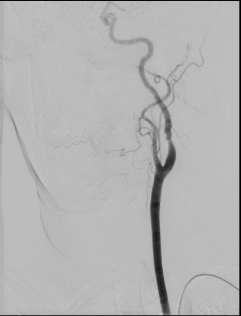 Angiographie der Arteria carotis interna links