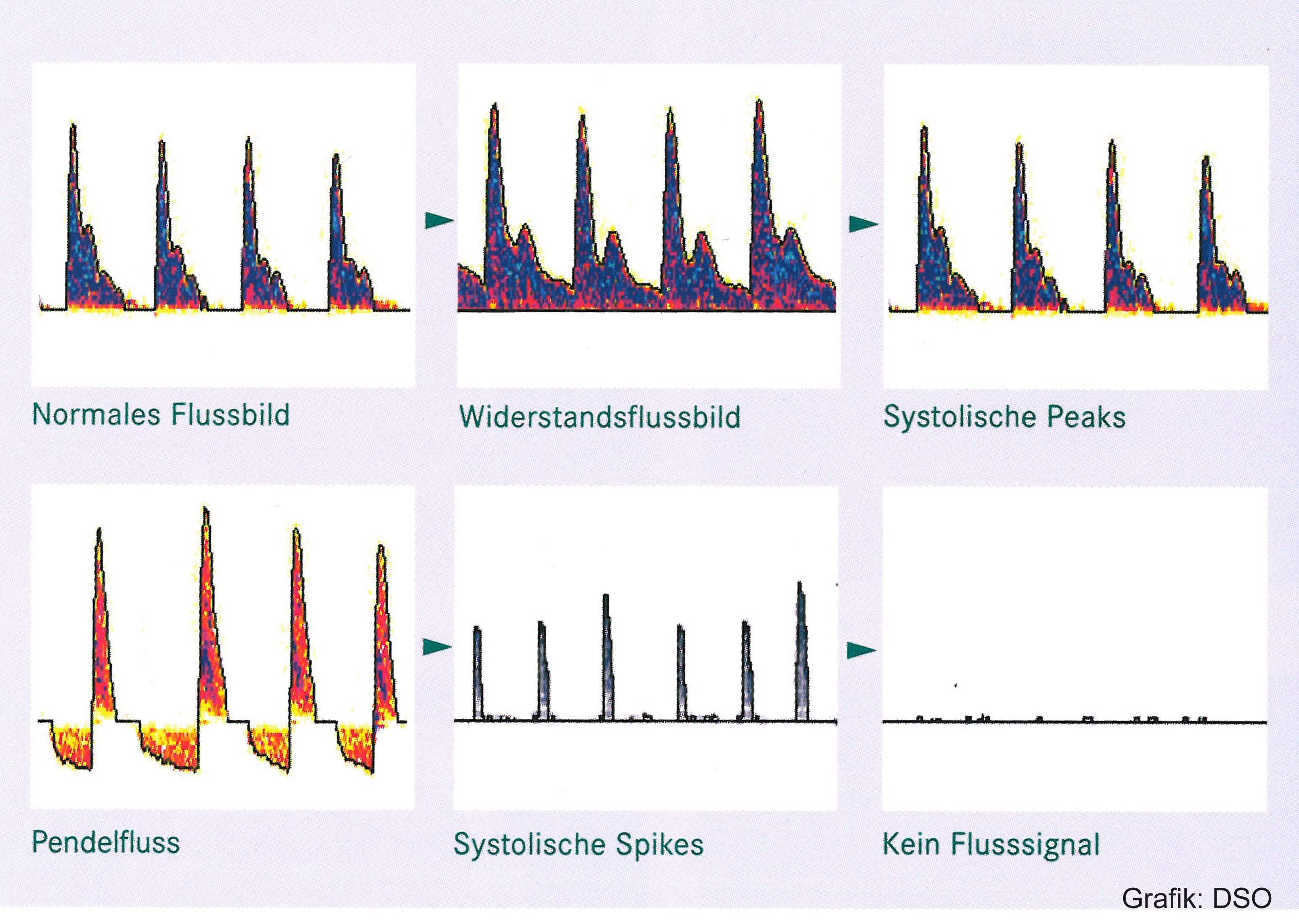 Frequenzspektren der transkraniellen Dopplersonographie