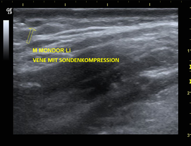 Abbildung 2: Duplexsonographische Beurteilung einer strangförmigen subkutanen Verhärtung. Quelle: Angiologie, Benedictus Krankenhaus, Tutzing