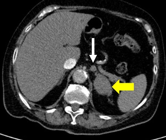 Nativ-CT-Befund mit miterfasstem Oberbauch der Patientin. Der gelbe Blockpfeil kennzeichnet den Nebennierentumor, der kleine weiße Pfeil die umgebende Lymphadenopathie.