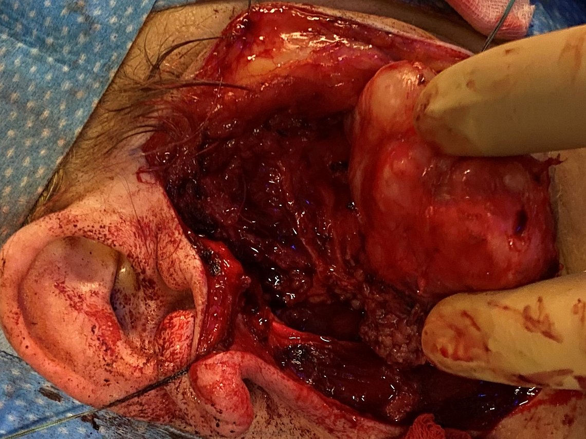 Intraoperatives Bild mit teilentferntem Tumor Intraoperatives Bild mit teilentferntem Tumor (rechts im Bild)