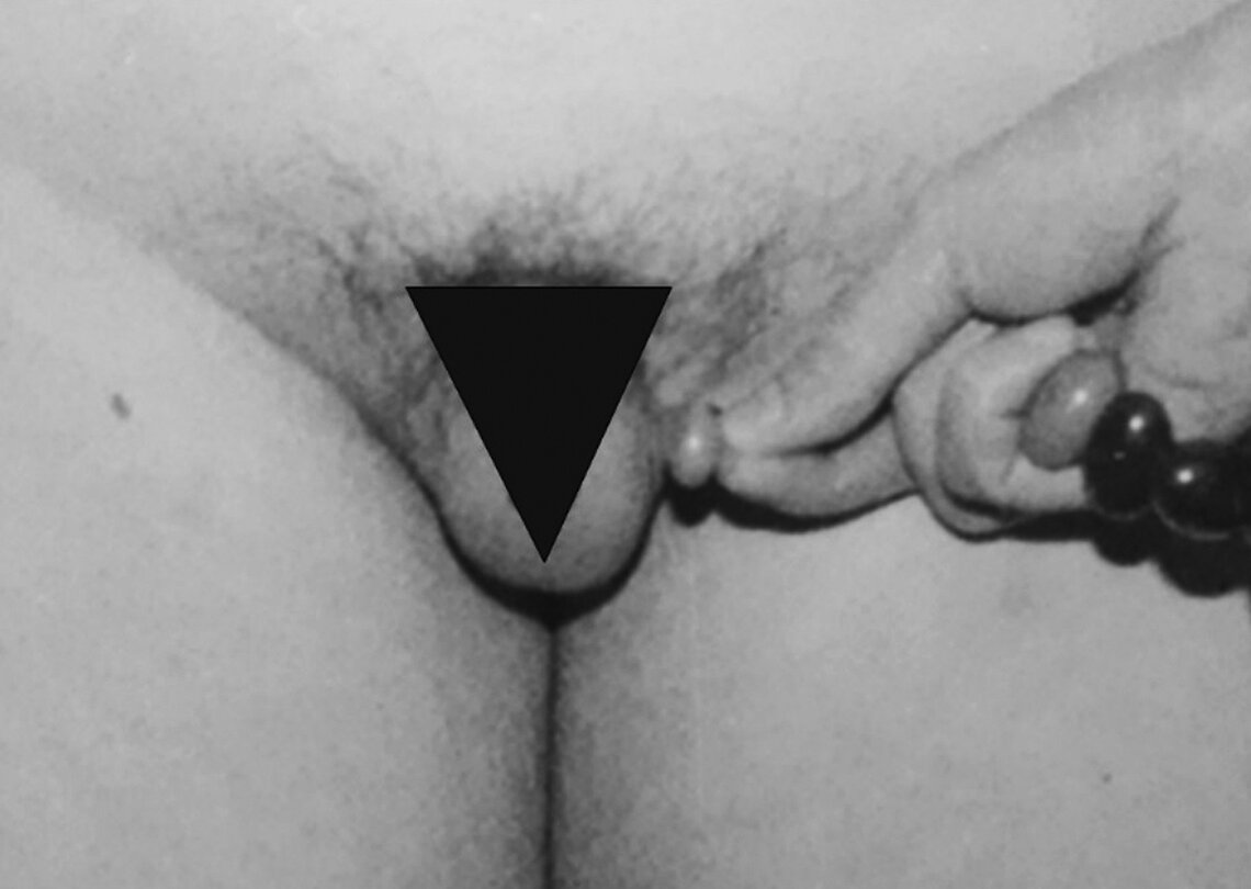 kasuistik-2022-10.jpg Testes des 19 Jahre alten Patienten, orchidometrisch gemessenes Volumen beidseits 2 ml