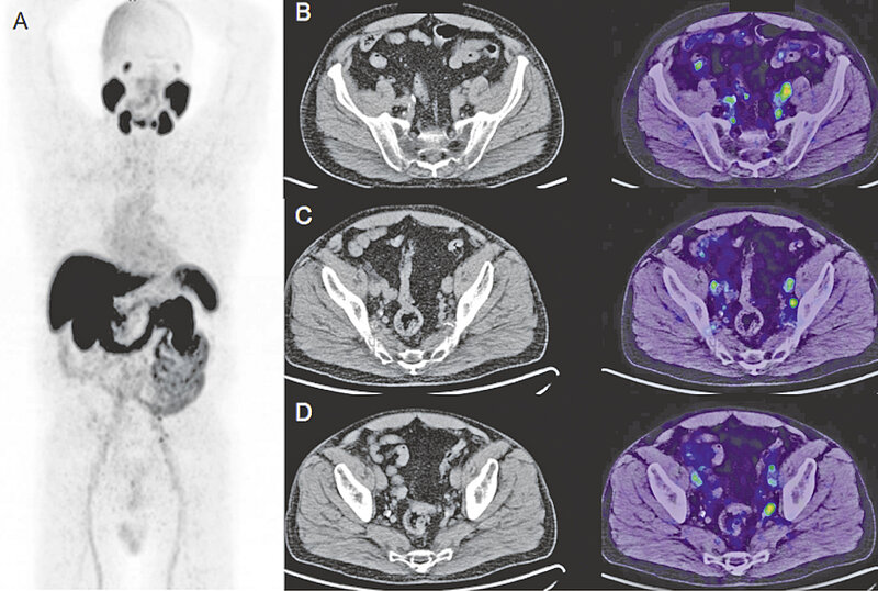 PSMA-PET/ CT von Patient 2