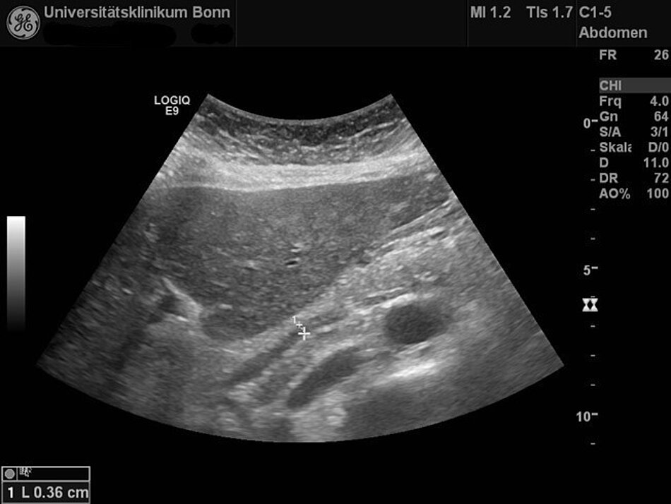 Ultraschallbild von Leber und Gallengängen