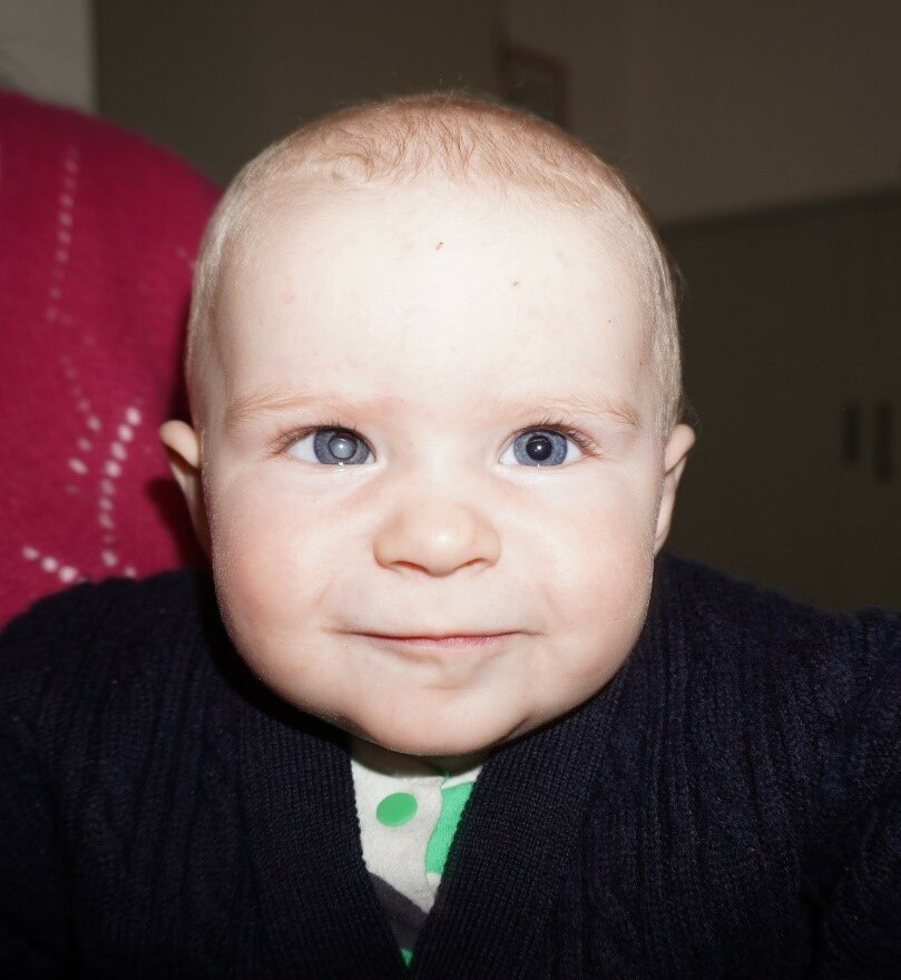 Zehn Monate alte Patientin mit hellem Reflex in der rechten Pupille.