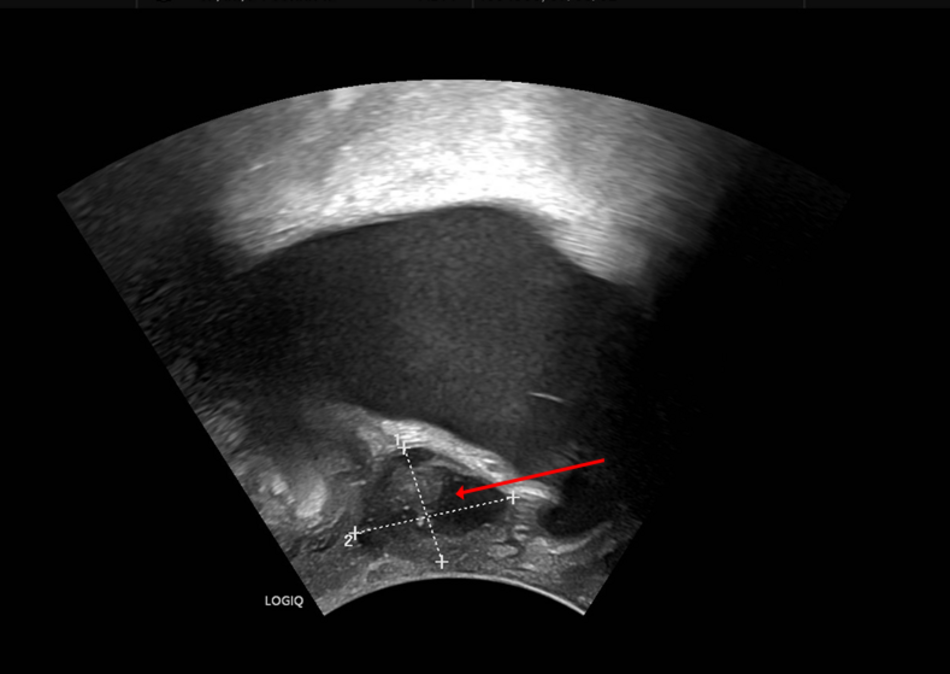 Suburethrale Raumforderung