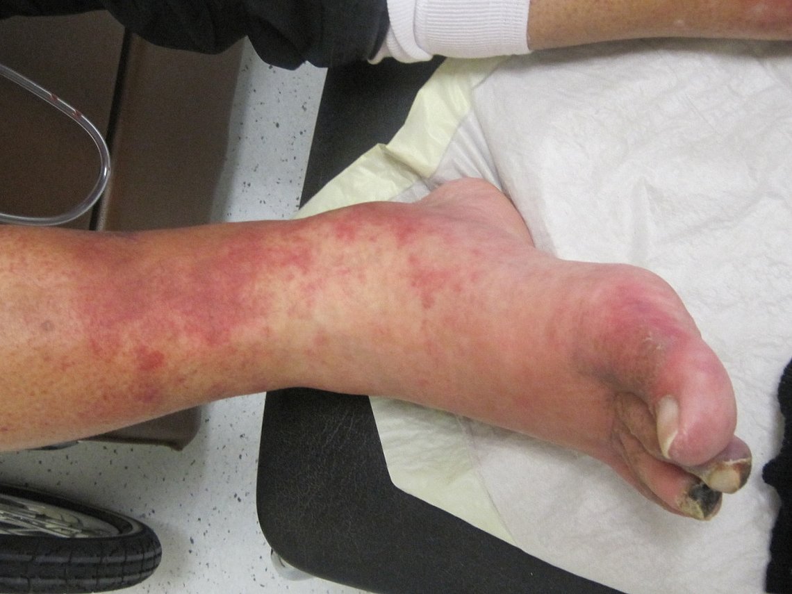 63-exanthem-vasculitisch.jpg vasculitisches Exanthem und Vorfußschwellung