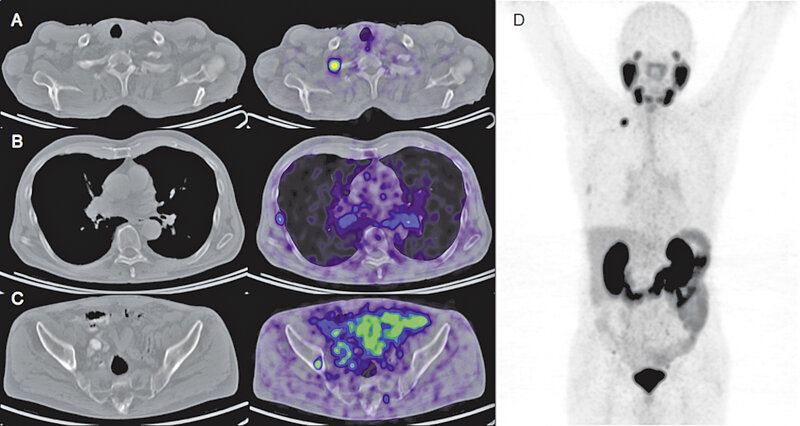 PSMA-PET/ CT von Patient 1