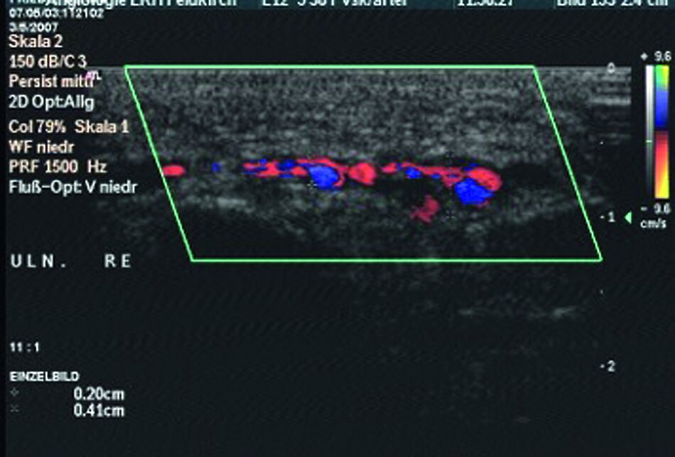Duplexsonographische Darstellung