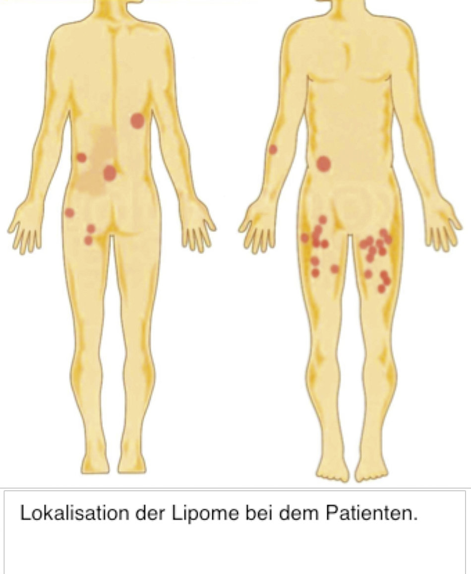 Lokalisation der Lipome