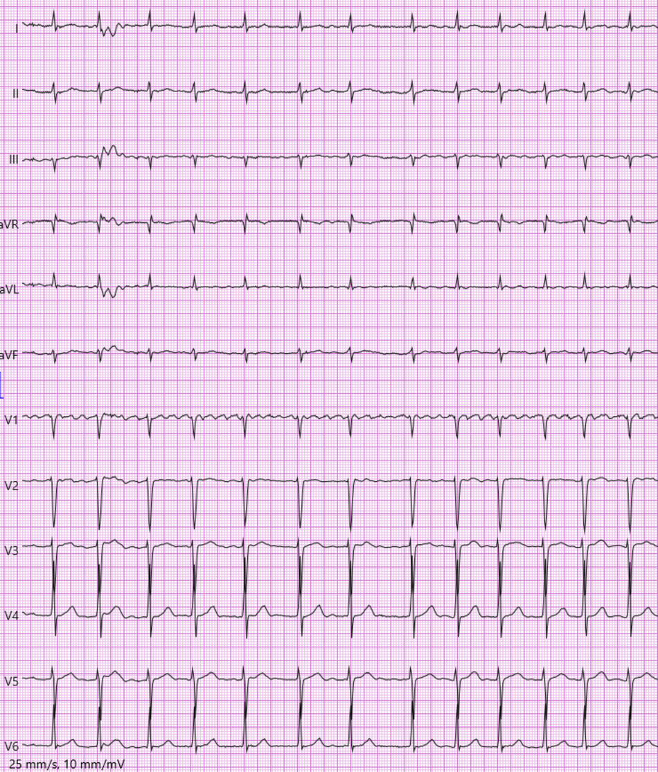 EKG der in der Kasuistik beschriebenen Patientin