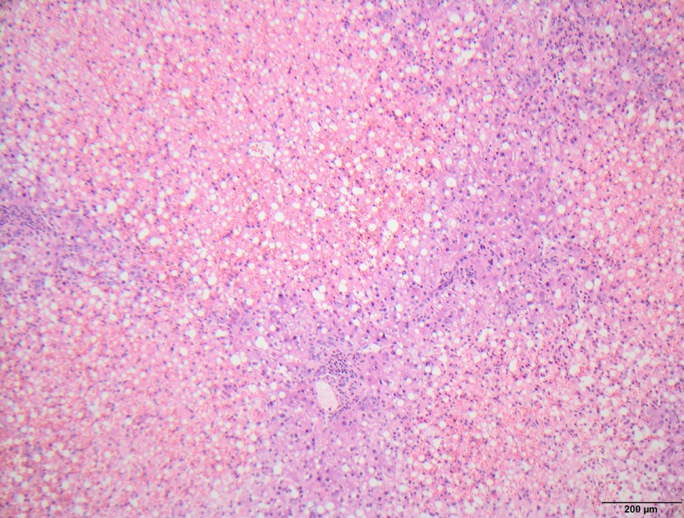 invasive squamous cell carcinoma larynx