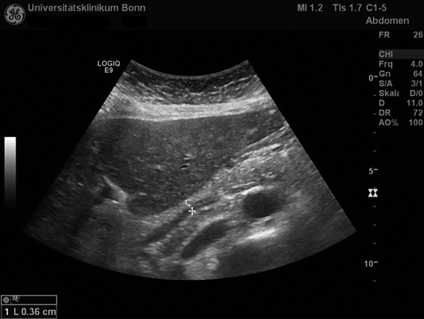 Ultraschallbild von Leber und Gallengängen der Patientin.