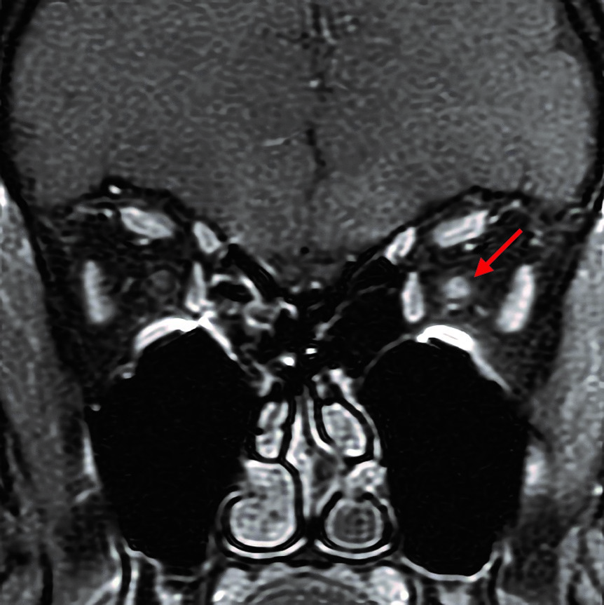MRT des nervus opticus