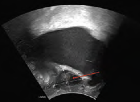 Suburethrale Raumforderung
