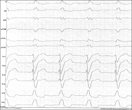 Ruhe-EKG