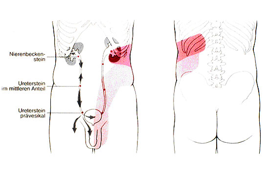 Schmerzfortleitung entsprechend der Steinlokalisation