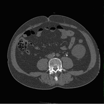 Aufnahme eines etwa 5 mm messender Stein im oberen Drittel des linken Ureters