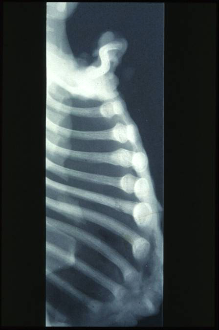 Röntgenaufnahme einer Rippenfraktur eines Kleinkindes