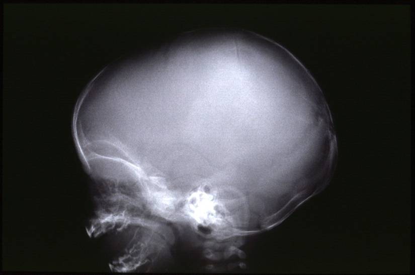 Röntgenbild eines Schädelbruchs eines Kleinkindes