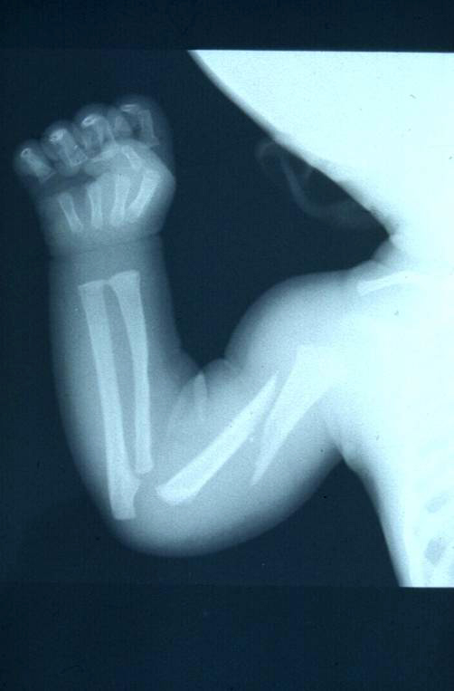 Röntgenbild Spiralbruch Oberarm einer Kleinkindes