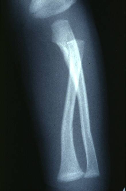Röntgenbild eines Unterarmbruches eines Kleinkindes