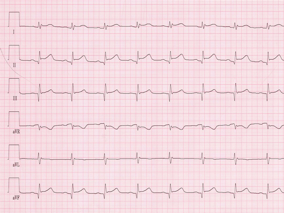 infarkt-typische ST-Streckenhebungen