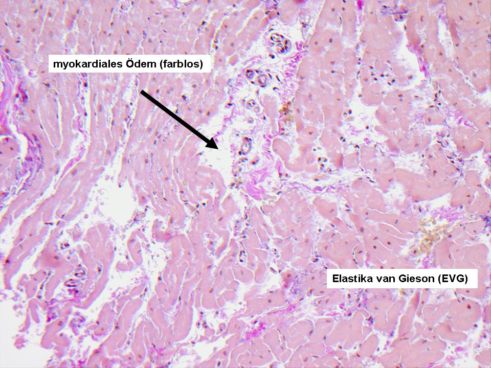 Histologischer Befund der Myokardbiopsie