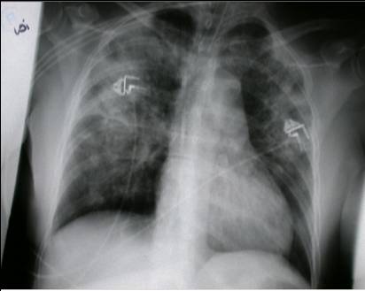 Röntgen-Thorax der Patientin