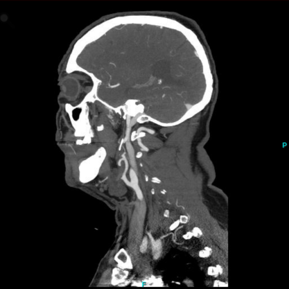 CT-Antiographie