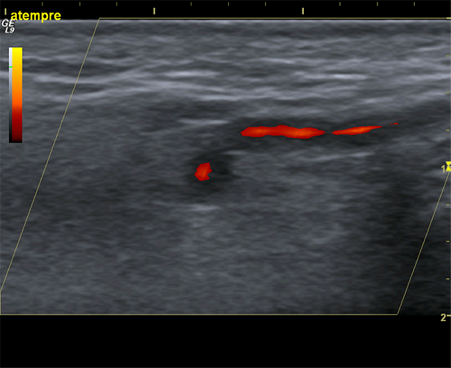 Farbduplexsonographische Untersuchung der A. temporalis rechts