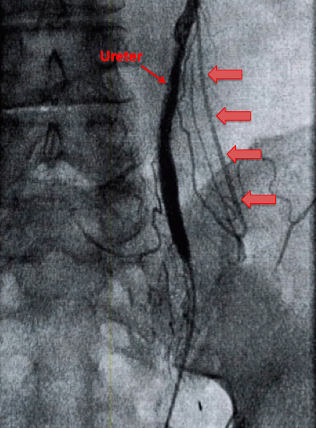 retrograde Ureteropyelographie im Rahmen der transuretralen Harnleiterschienung links