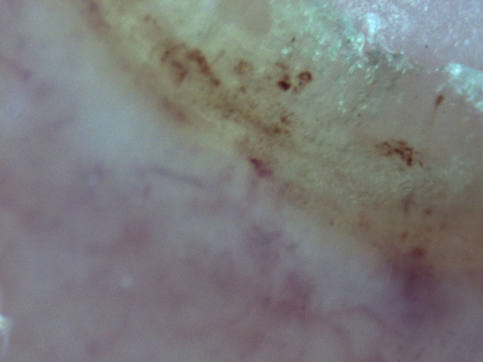 Abbildung 3: Kapillarmikroskopie mit Ödem, fehlender Kappilardurchblutung und punktförmigen Blutungen.