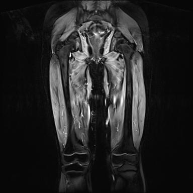 Abbildung 4: Diffus ödematös entzündliche Muskelveränderungen der Oberschenkel, vereinzelt auch der Glutealmuskulatur. (MRT in STIR Technik, koronare Schichtung).