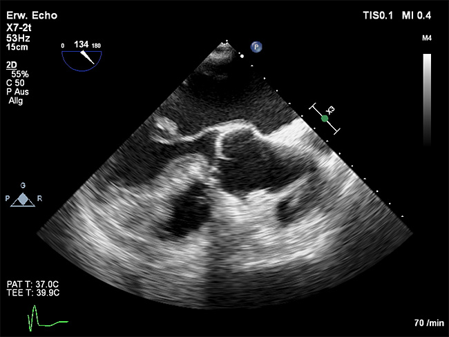 Transösophageale Echodardiographie