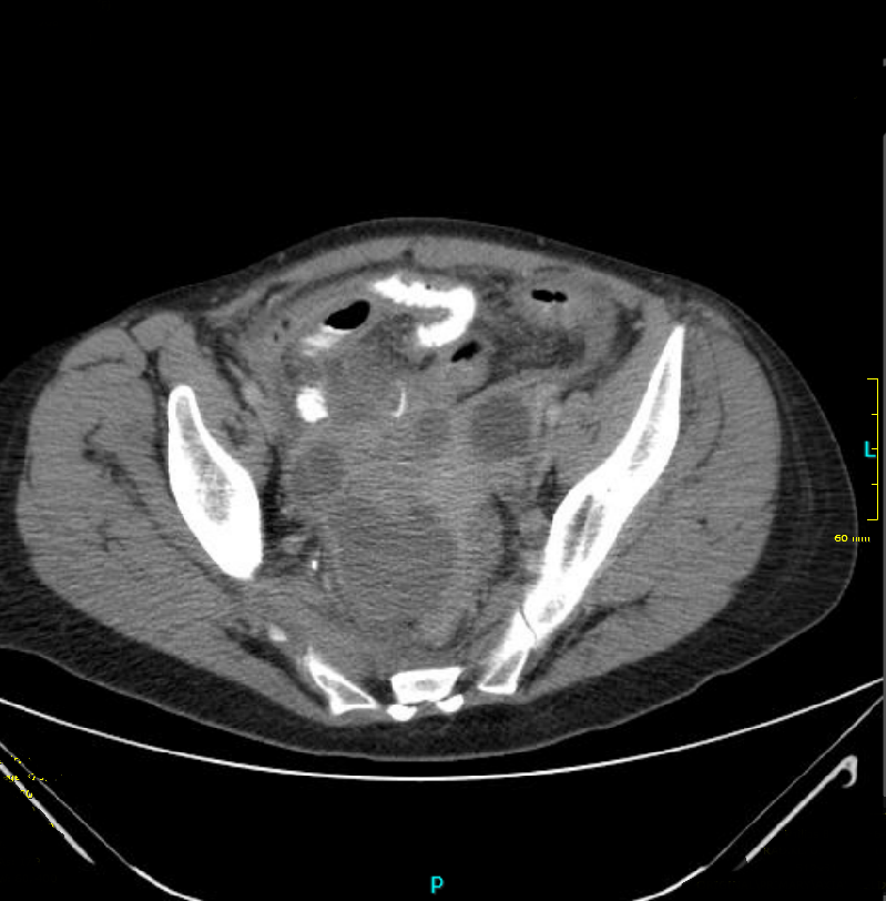 Computertomographie des Abdomens