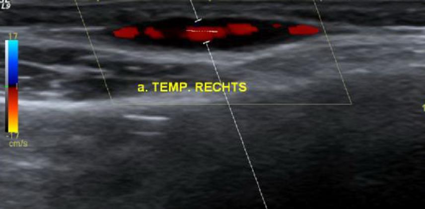 Sonografie A. temporalis