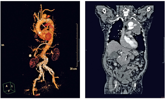 CT-Abdomen-Thorax