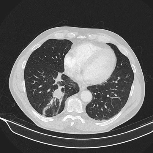 CT-Thorax