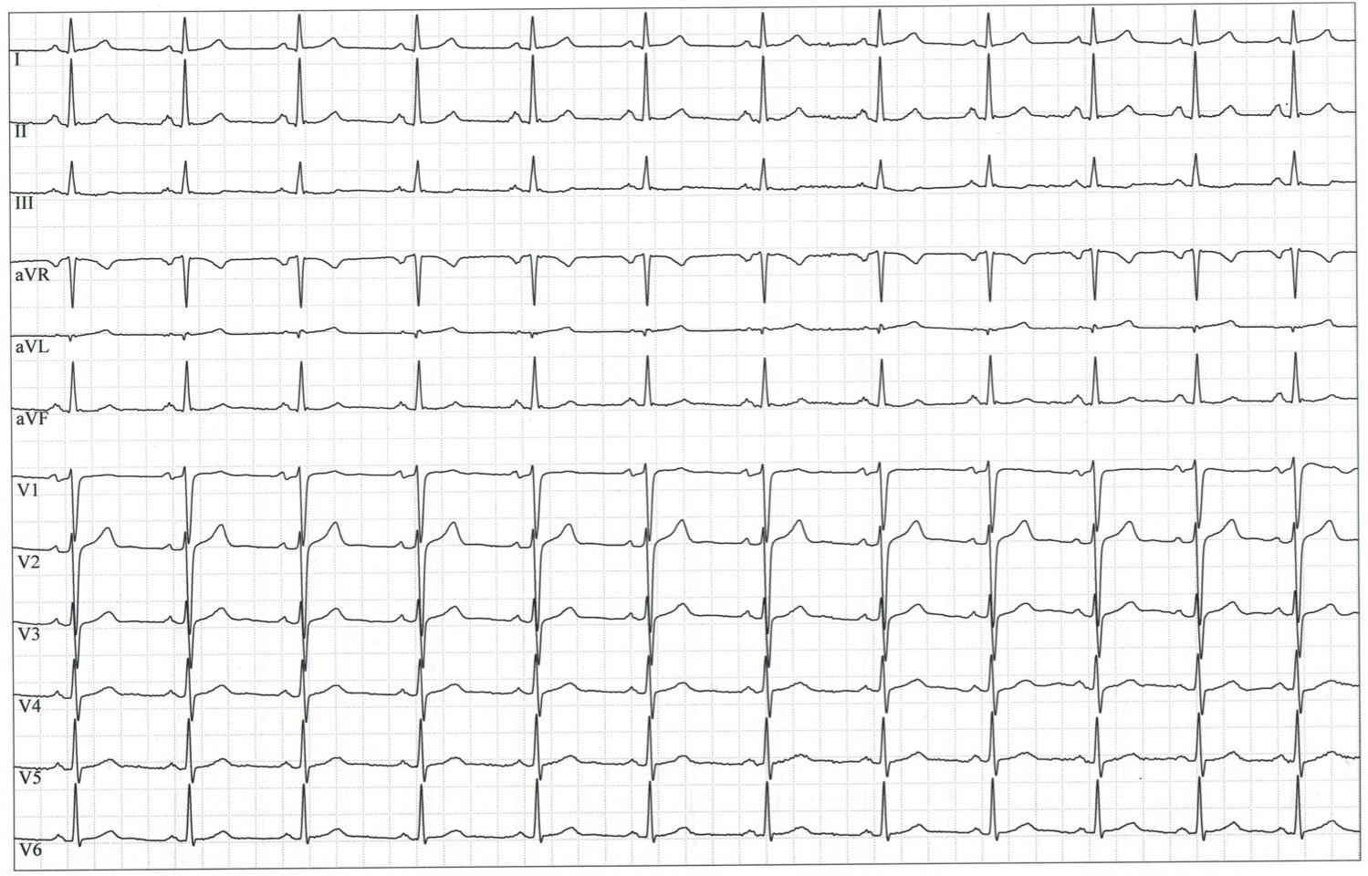 EKG am Aufnahmetag