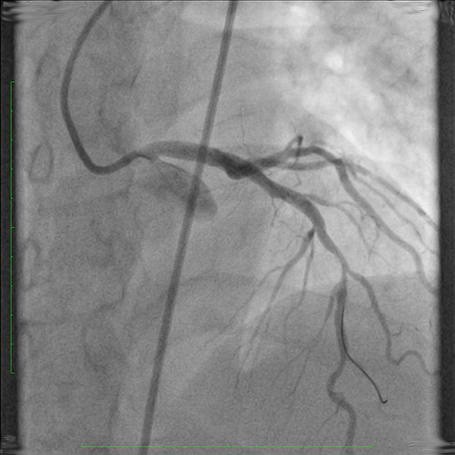 Koronarangiographie mit Stent