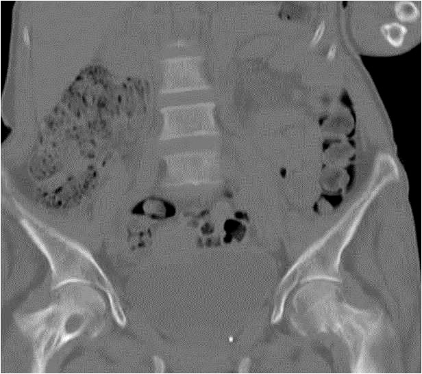 Abbildung 1: CT-LWS-/Beckenknochen und Hüftknochen der Patientin mit Osteolysen