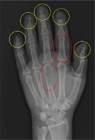 Abbildung 2: Röntgenbild linke Hand