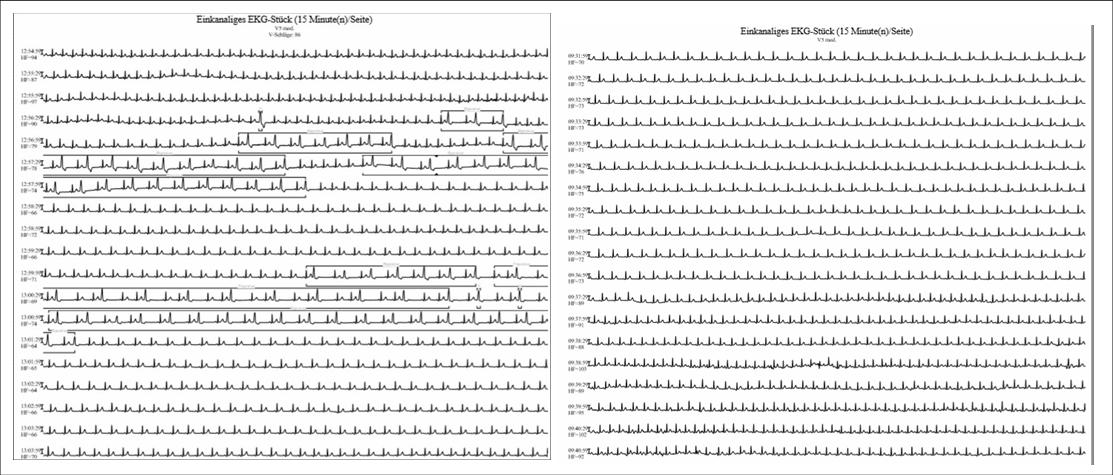 Abbildung 1: links: LZ-EKG (Ausschnitt) vor Ablation, rechts Langzeit-EKG (Ausschnitt) nach Ablation Quelle: Benedictus Krankenhaus, Tutzing