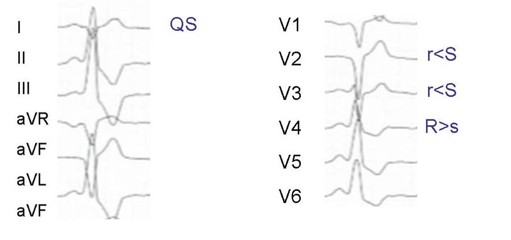 Abbildung 4: Klinische VES des aktuellen Falles mit Ursprung im RVOT, anterior (anterolateral) und superior. Quelle: Benedictus Krankenhaus, Tutzing