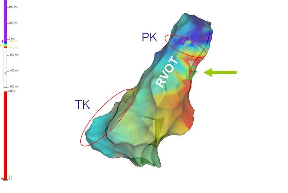 Abbildung 5: Anterolaterale und superiore Lokalisation des Fokus im RVOT (+) visualisiert mittels 3D-Mapping (Ensite NavX, Abbott) Quelle: siehe Literatur Nr. 10