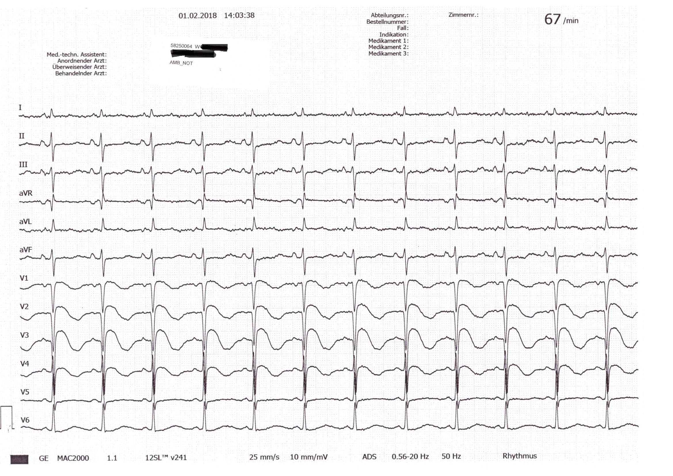 EKG der Patientin bei Aufnahme. Quelle: Benedictus Krankenhaus, Tutzing