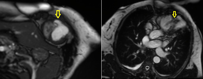 Magnetresonanztomographie des Herzens der Patientin der vorliegenden Kasuistik Quelle: Benedictus Krankenhaus, Tutzing