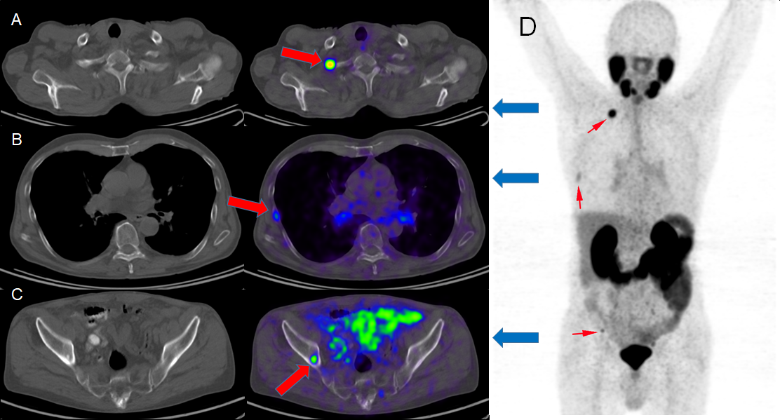 PET/CT-Bildgebung des Patienten 1