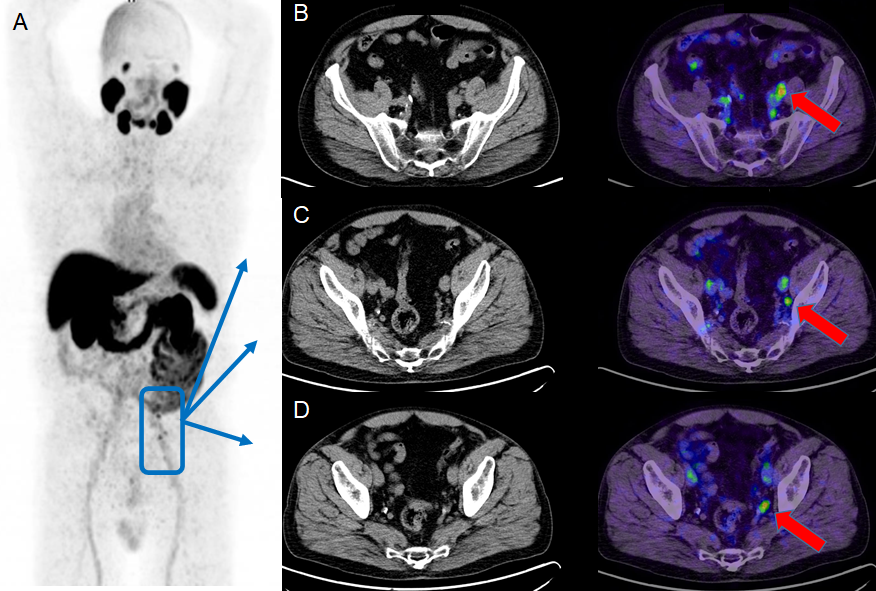 PET/CT-Bildgebung des Patienten 2